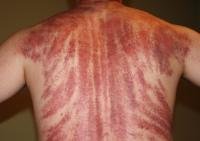 Thumbnail of Tips Untuk Kerokan Yang Aman, Baik Dan Benar!